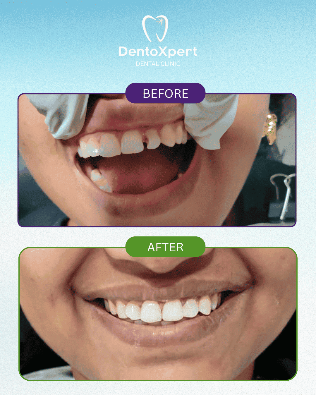 Before and after dental treatment result at DentoXpert Dental Clinic in Thane